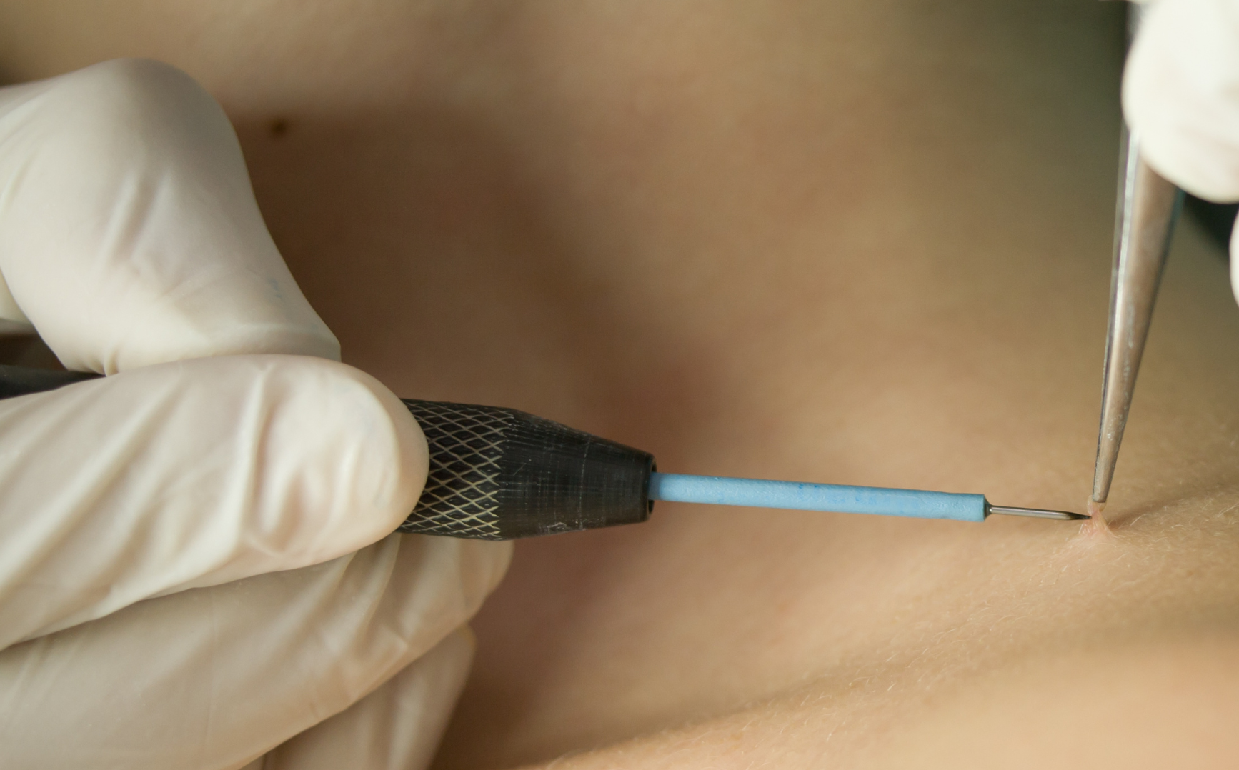 Czym są brodawki? Jak pozbyć się brodawek?