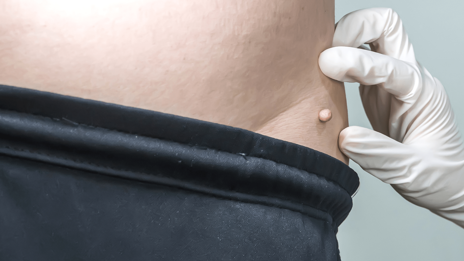 Co to są włókniaki? Jak usunąć włókniaki?