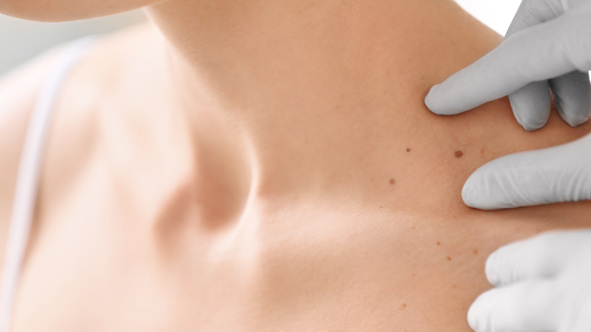 Na czym polega zabieg wymrażania zmian skórnych?