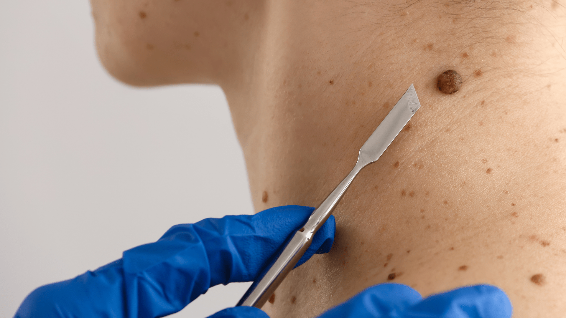 Jak się pozbyć zmian skórnych?