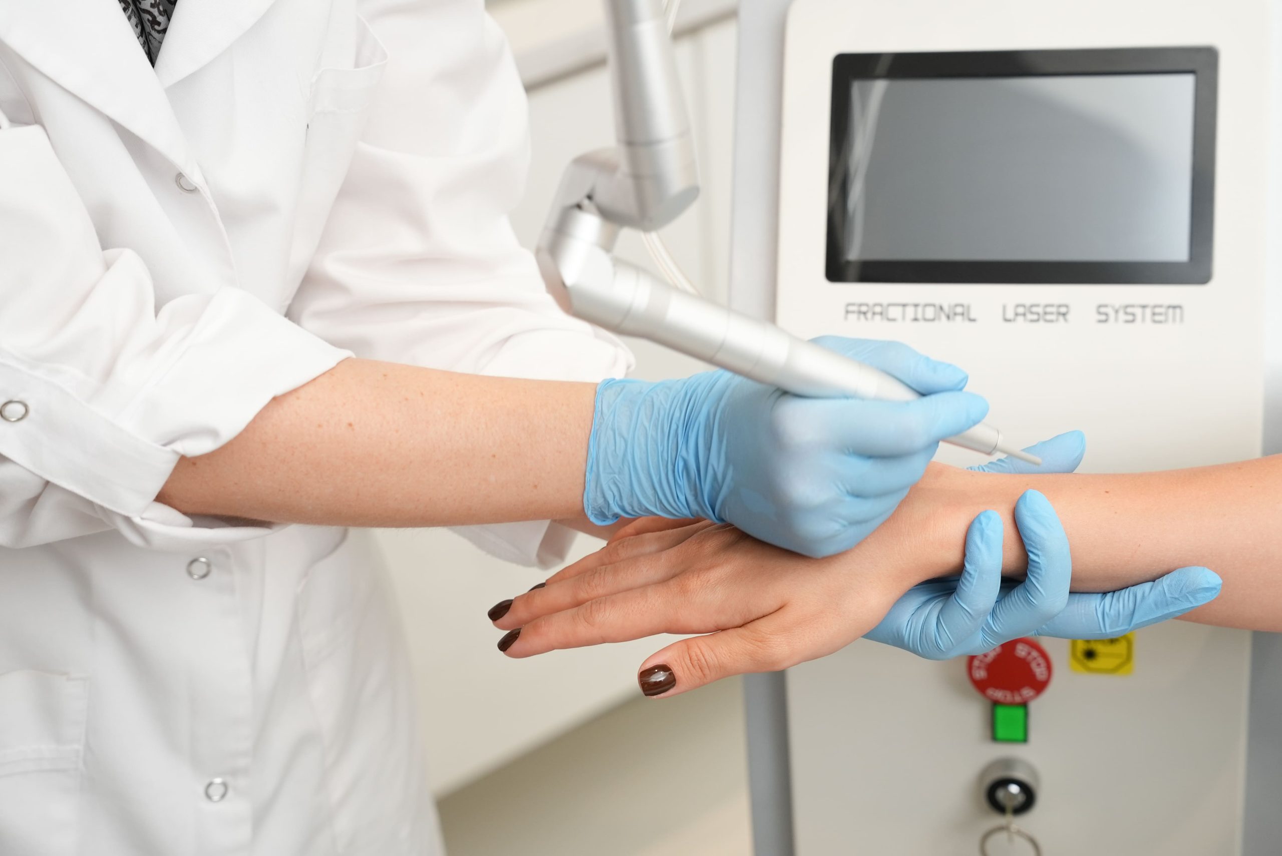 Na czym polega laserowe usuwanie brodawek?