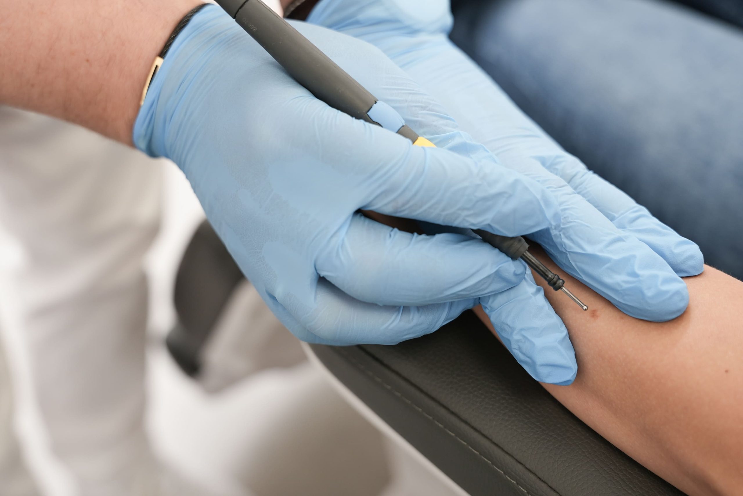 Lekarz w niebieskich rękawiczkach przeprowadza zabieg elektrokoagulacji na ręce pacjentki