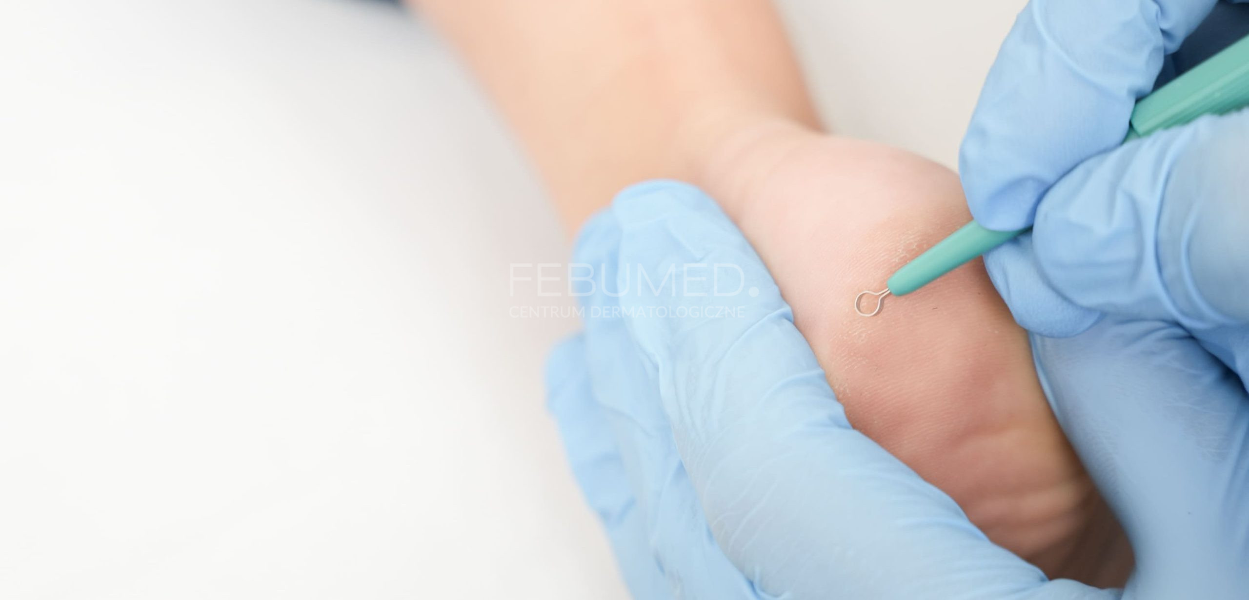 Lekarz w niebieskich rękawiczkach wykonuje łyżeczkowanie na stopie pacjentki