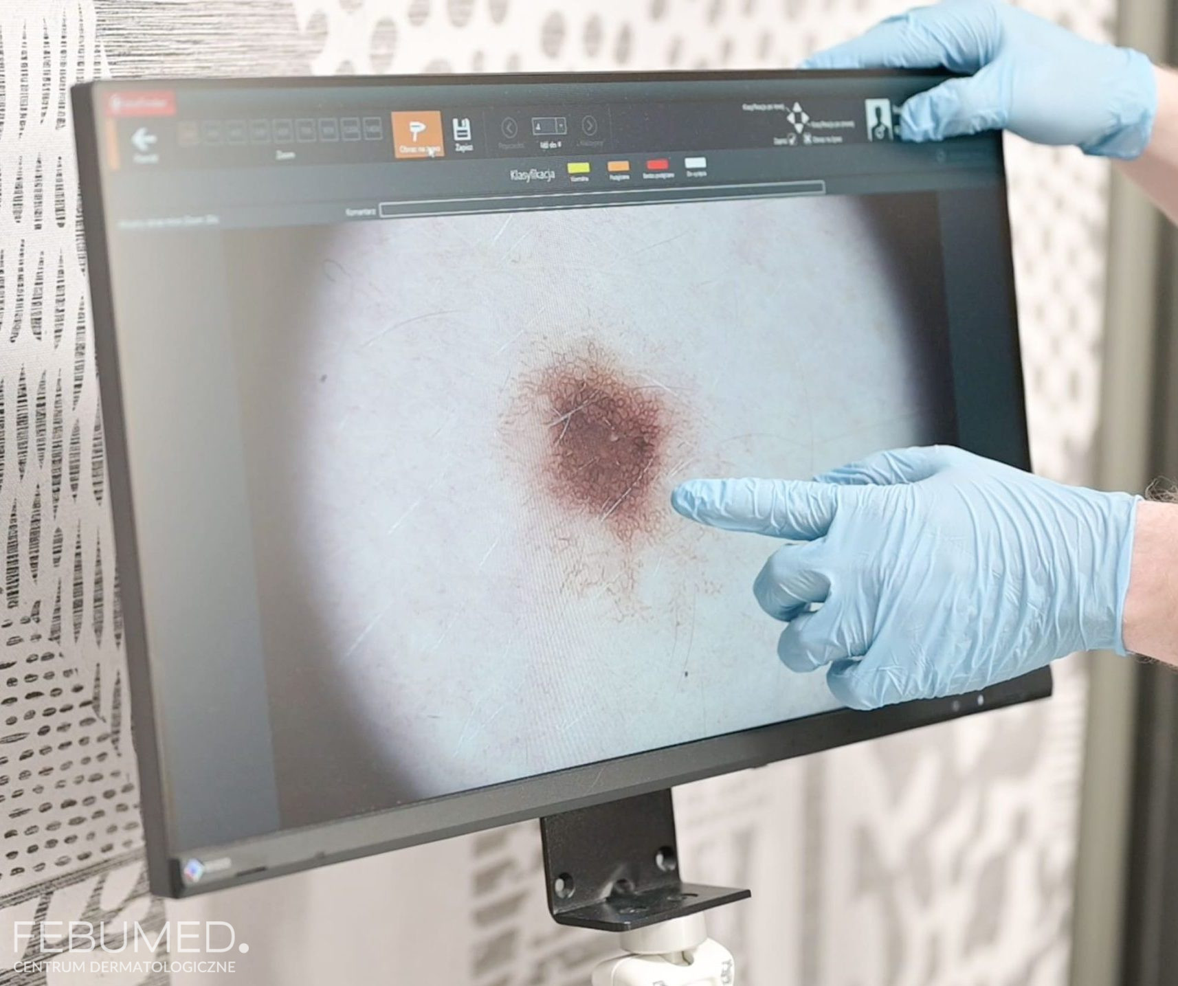 lekarz wskazujący zmianę skórną na ekranie