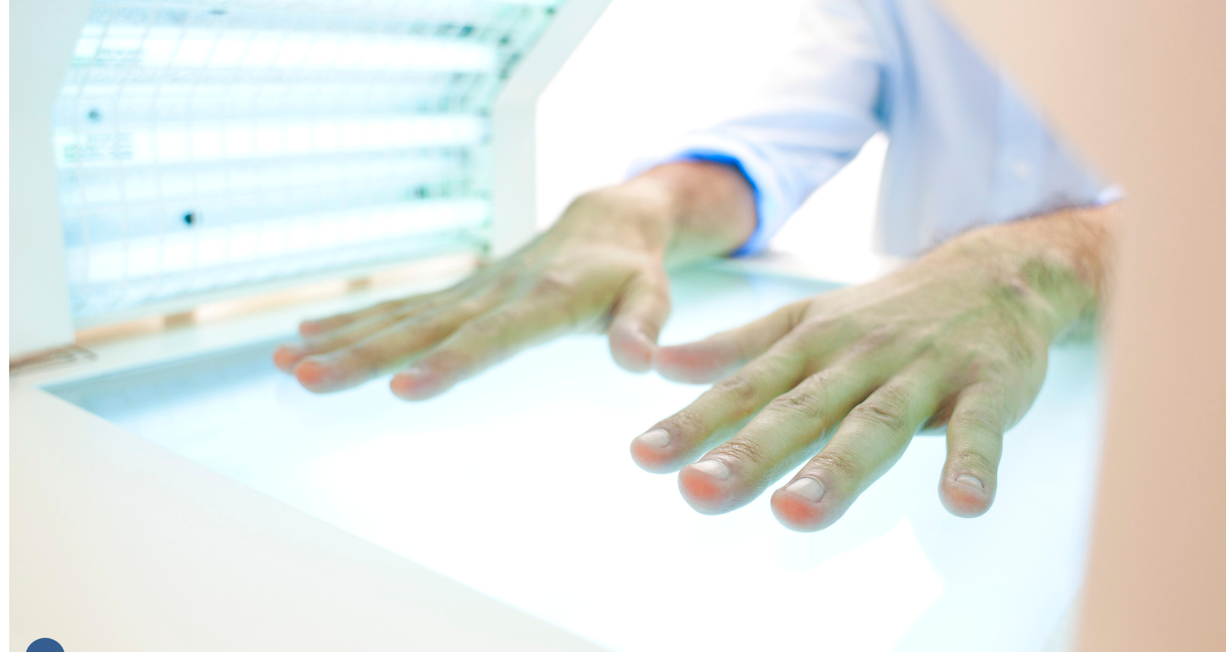 dłonie pacjenta podczas naświetlania PUVA pod lampą