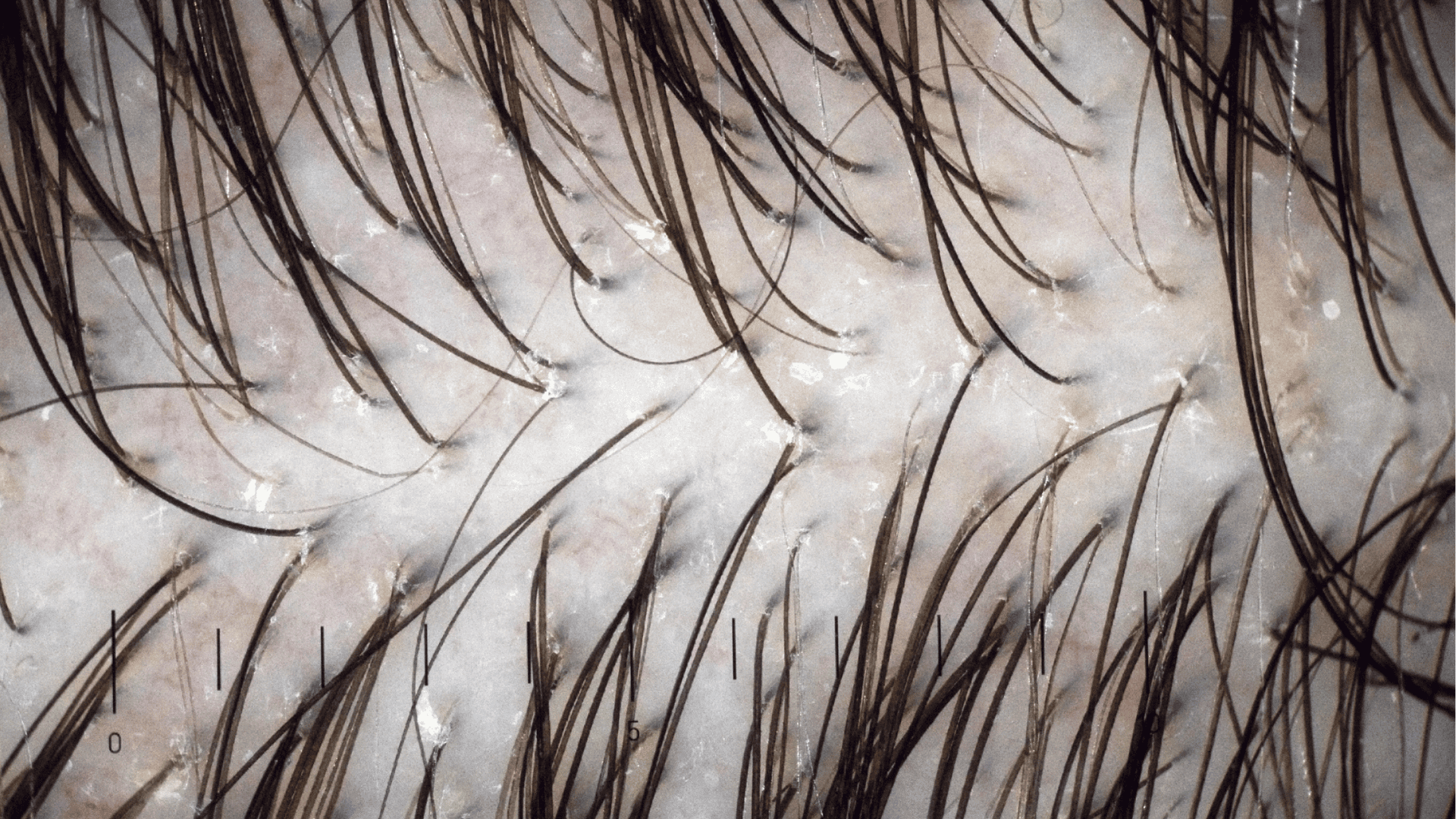 zbliżenie na skórę głowy z pokazaniem mieszków włosowych