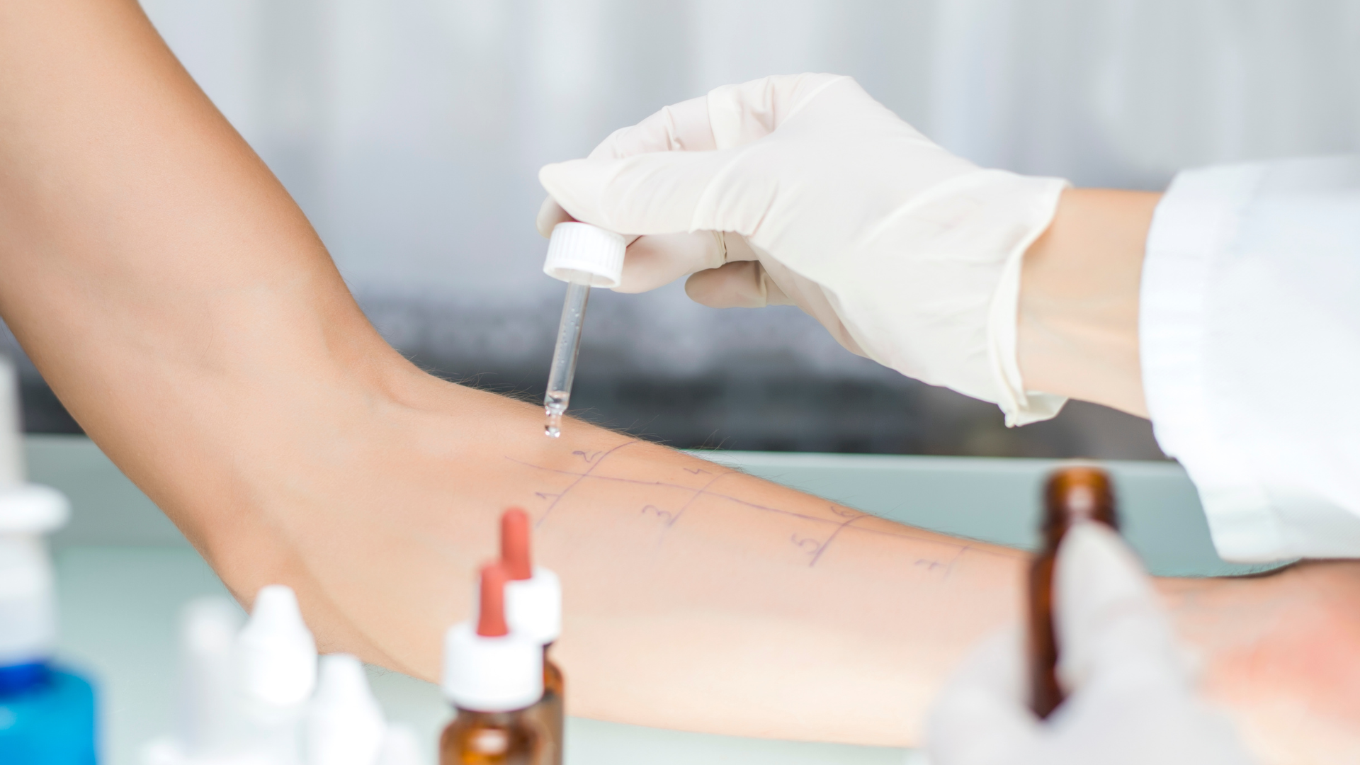 Alergolog wykonuje testy alergiczne na pacjencie metodą skórnych testów punktowych poprzez nałożenie kropli alergenu na wewnętrzną część przedramienia. W tle widać małe buteleczki z alergenami.