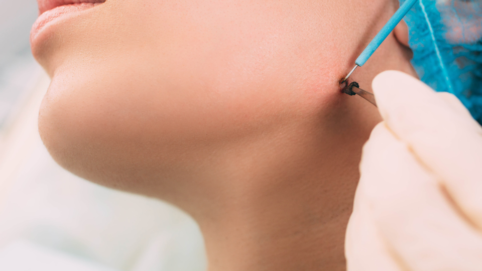 Dolna część twarzy kobiety podczas zabiegu, kończy usuwać zmianę skórną za pomocą elektrody igłowej.