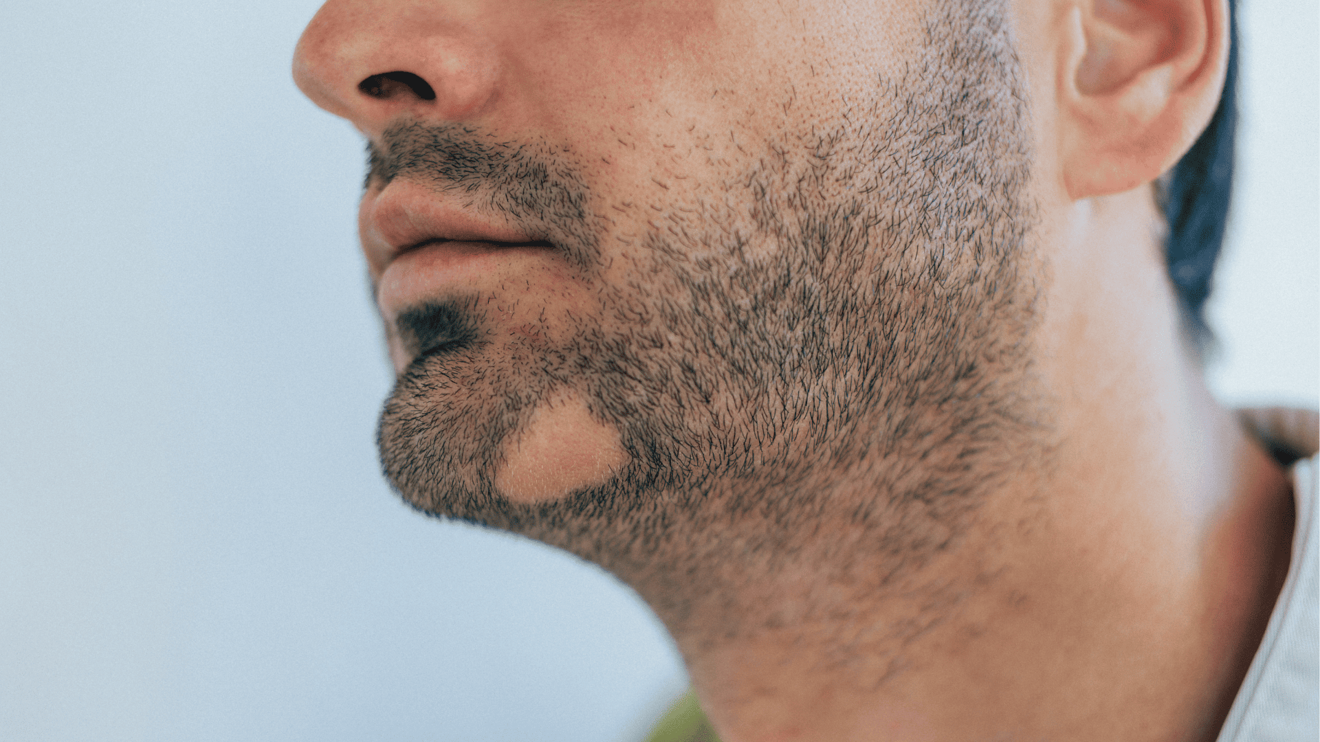 mężczyzna z łysą plamką na brodzie wywołaną łysieniem plackowatym