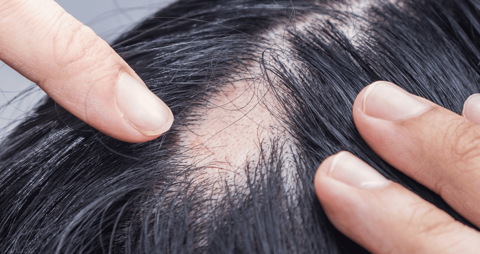 fragment skóry głowy kobiety z wyraźnie zaznaczonym łysym obszarem w wyniku łysienia plackowatego