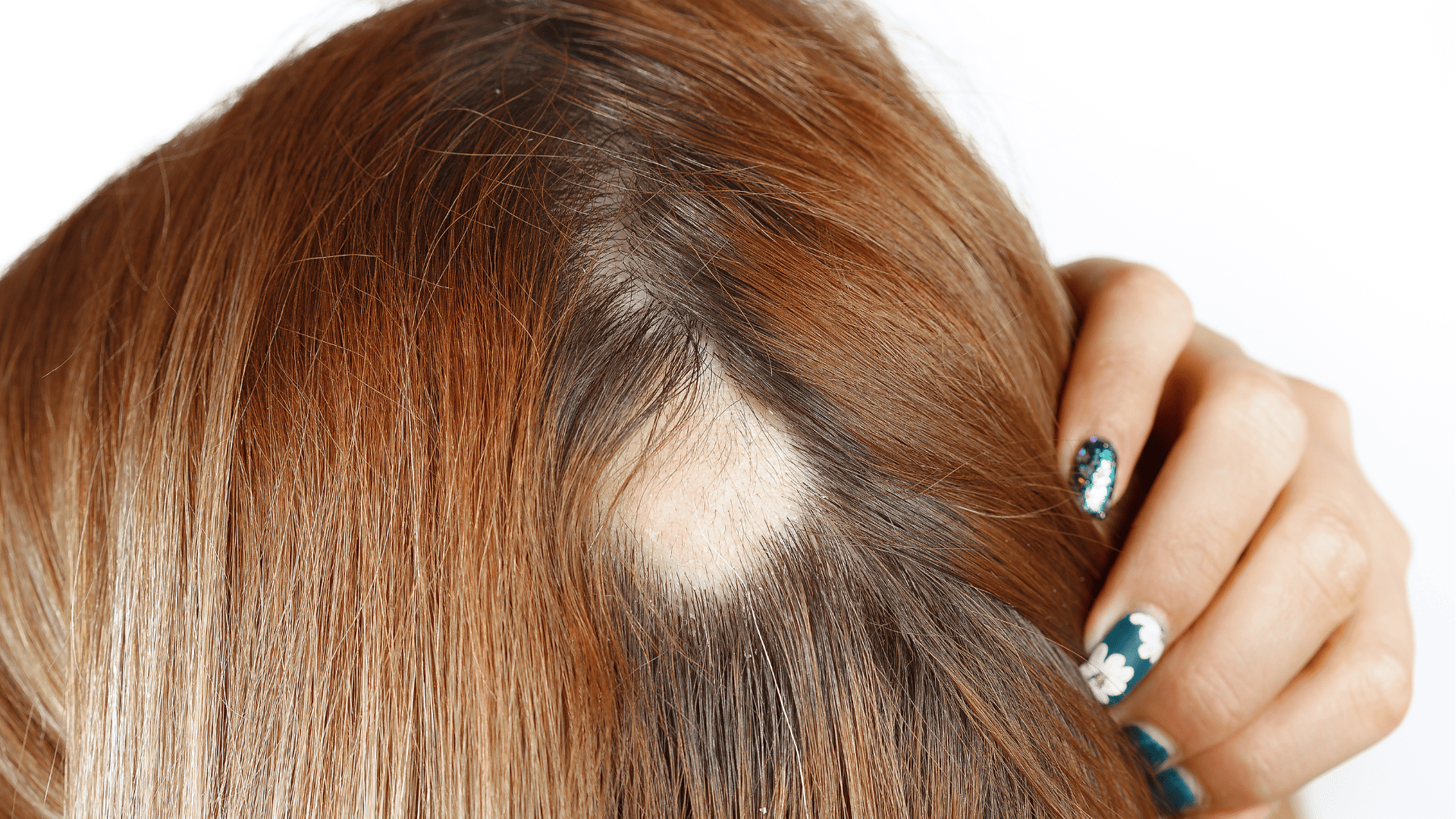 łysa plamka na tyle głowy kobiety z długimi brązowymi włosami, widoczna po odsłonięciu skóry głowy