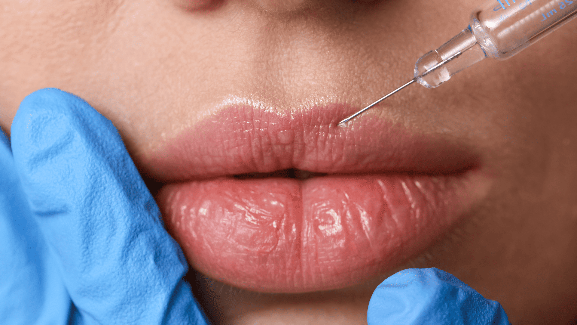 kobieta, która ma wykonywany zabieg powiększania ust za pomocą precyzyjnego wprowadzania kwasu hialuronowego cienką igłą