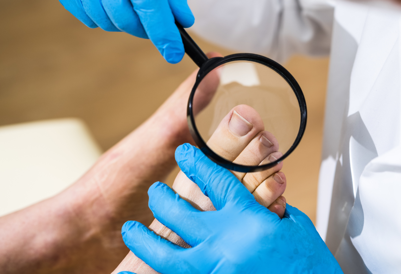 Lekarz w medycznych rękawiczkach i białym fartuchu sprawdzający stan paznokcia pacjenta lupom w celu oceny stanu paznokcia.
