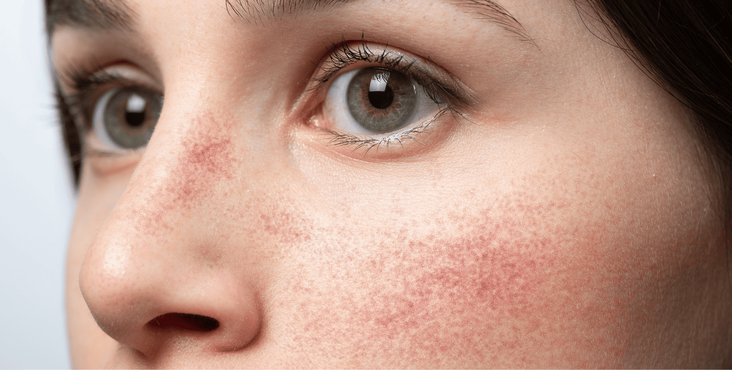 rumień na twarzy młodej kobiety – zaczerwienienia na policzkach i nosie