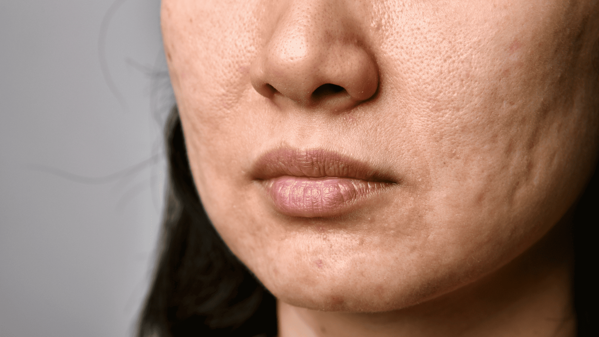 Zbliżenie na dolna część twarzy kobiety, mającą skórę pokrytą w blizny potrądzikowe.