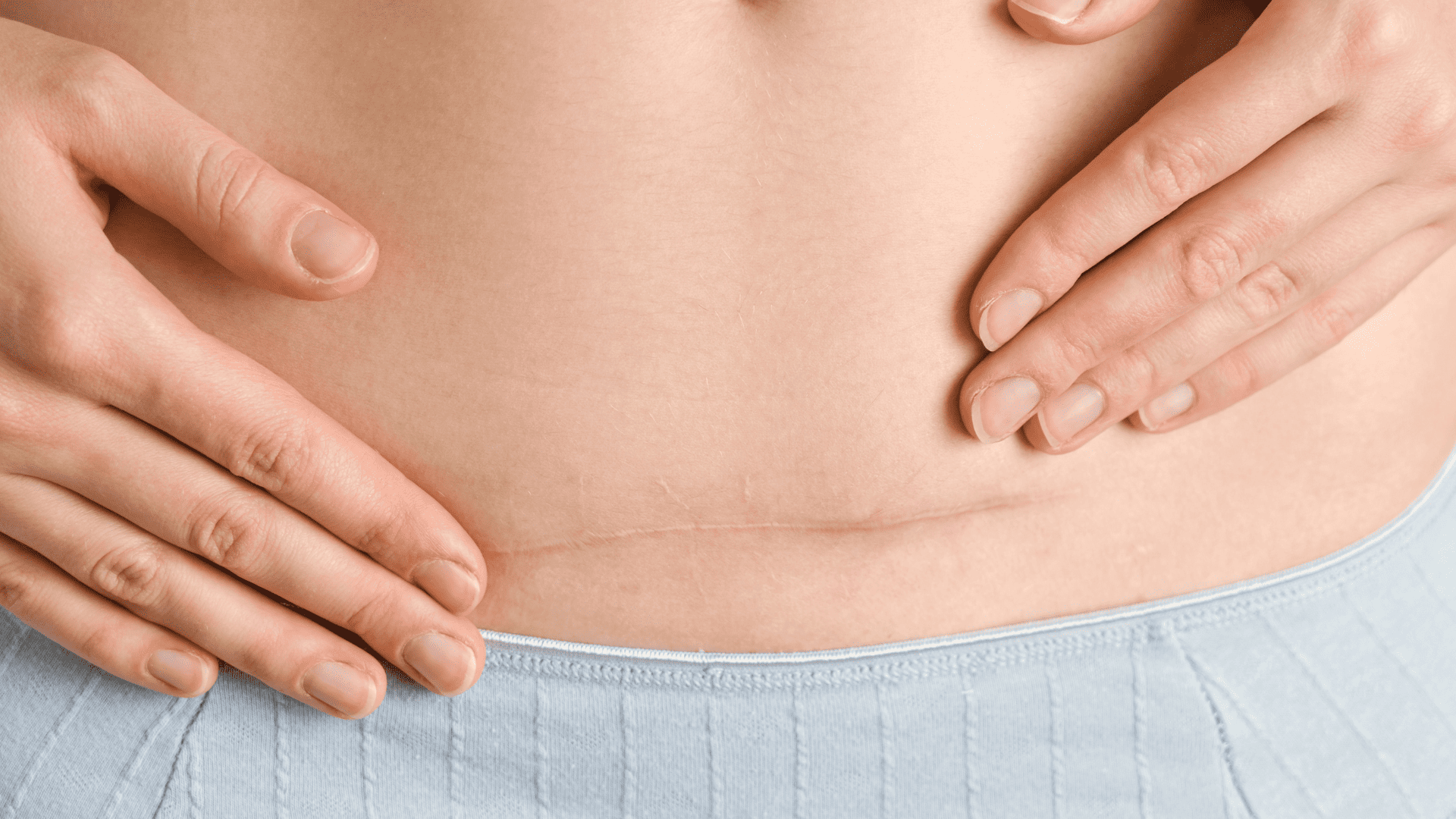 Zbliżenie na kobiecy brzuch z widoczną blizną po cesarskim cięciu