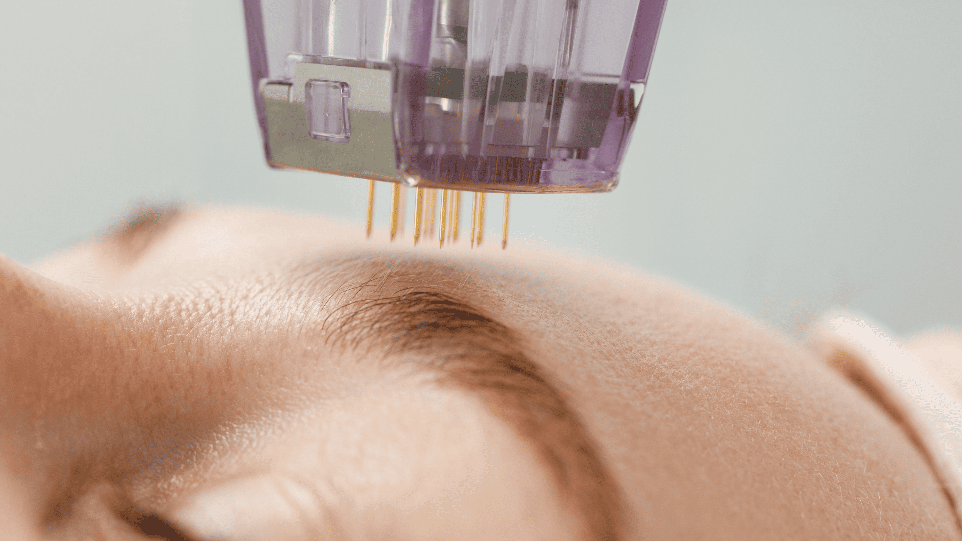 Zabieg radiofrekwencji mikroigłowej. Igły z głowicy wbijane w czoło kobiety.