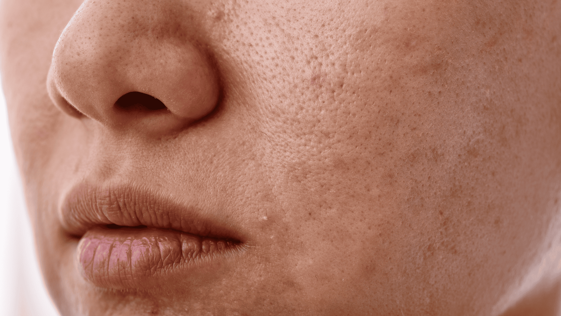 Zbliżenie na kobiecą twarz widoczną od połowy w dół z widocznymi przebarwieniami na policzku