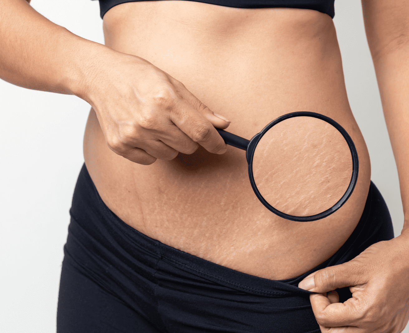 Zbliżenie na brzuch kobiety trzymającej lupę, skierowaną na rozstępy.