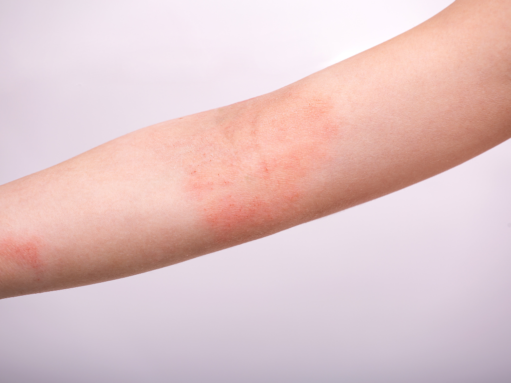 Przedramię z rozległymi czerwonymi plamami