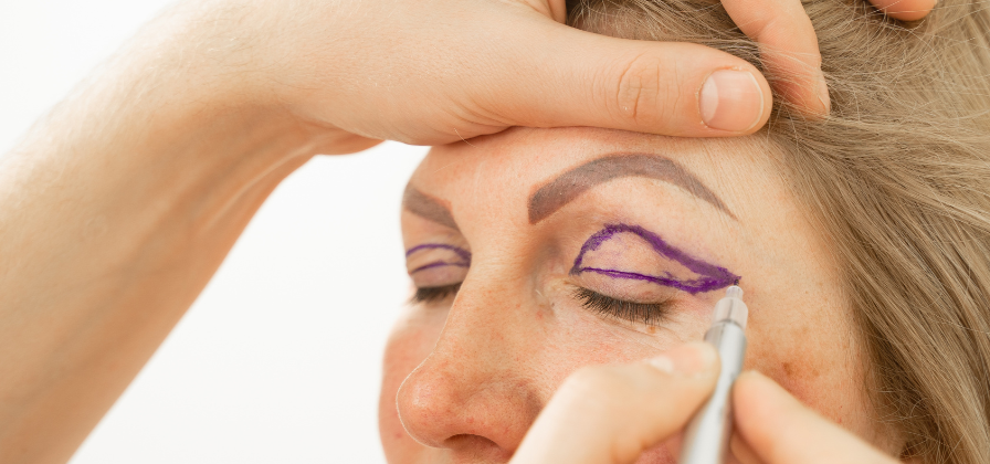 Lekarz zaznacza na powiece górnej zarys cięcia przed zabiegiem blefaroplastyki