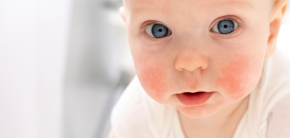 Urocze dziecko około 6 miesięcy z czerwonymi plamami na policzkach