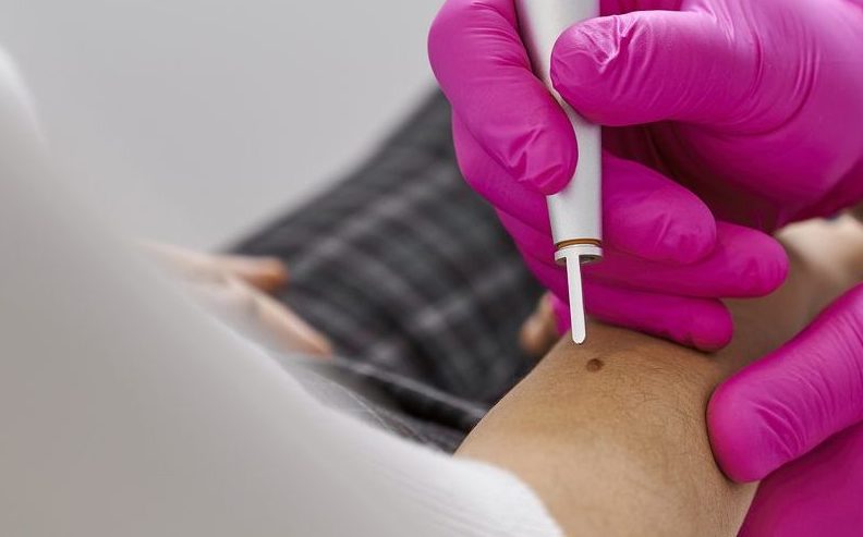 zabieg usuwania zmian skórnych w FEBUMED