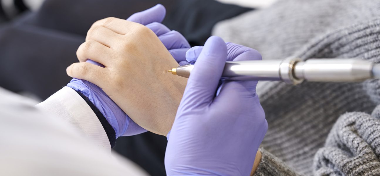 Czym jest kriochirurgia? Jakie zmiany skórne można wymrozić?