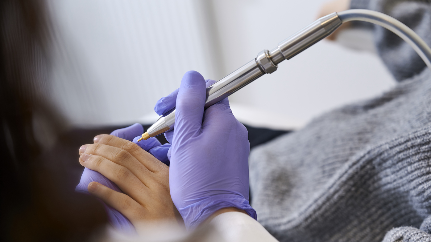 kriochirurgia kurzajki w FEBUMED