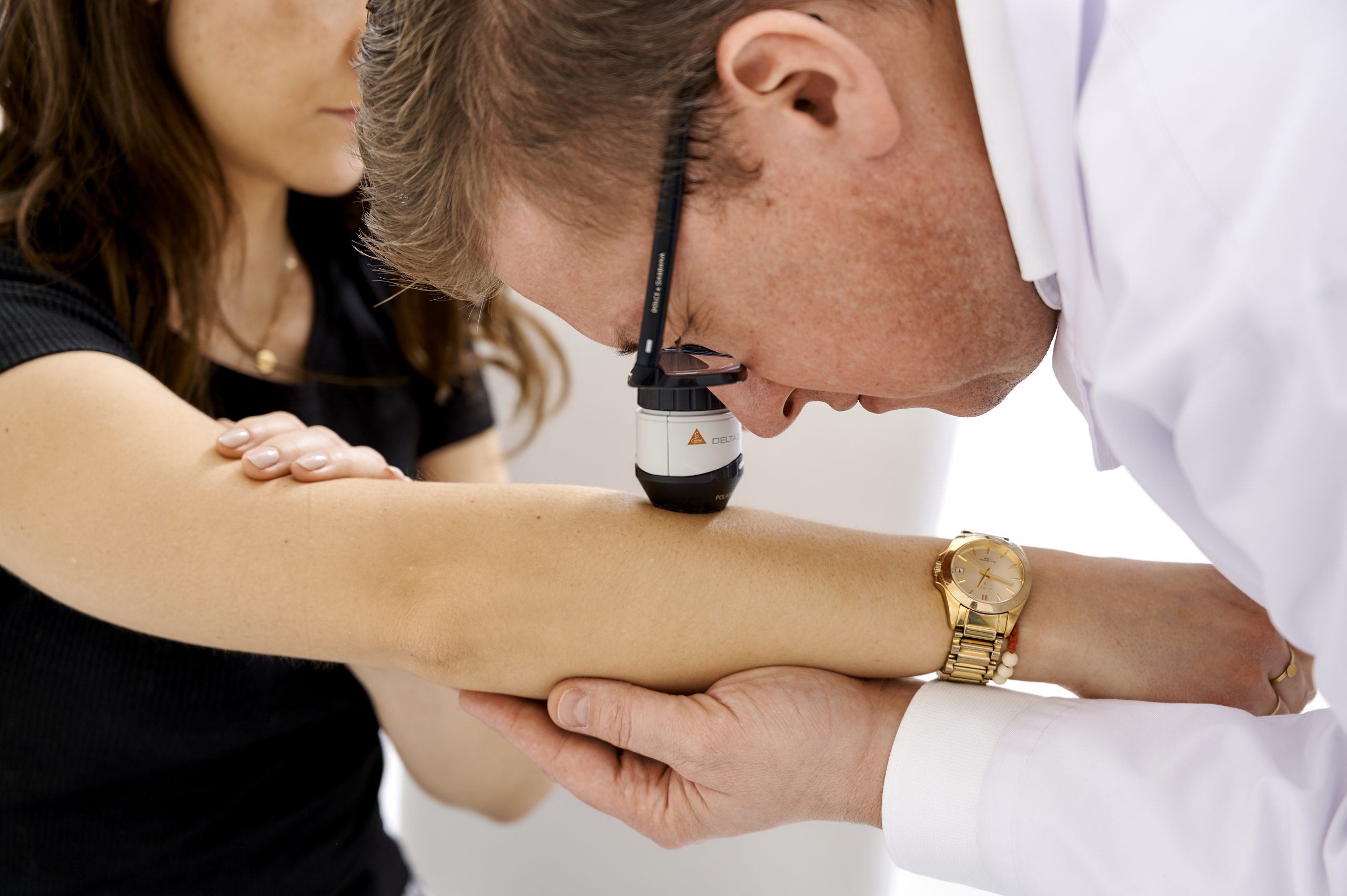 lekarz oglądający za pomocą dermatoskopu zmianę skórną na ręku pacjentki