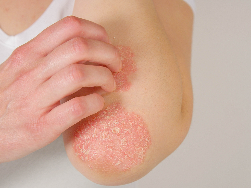 Zmiany łuszczycowe na łokciu – przewlekła choroba skóry powodująca złuszczanie i podrażnienie