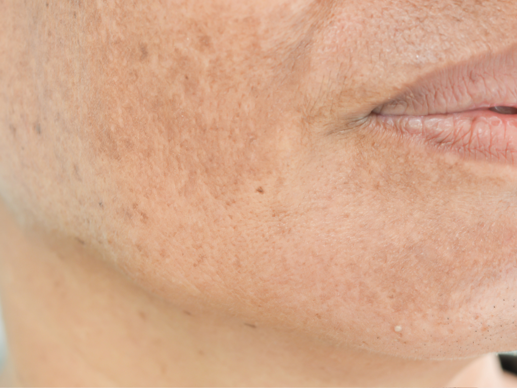 Melasma czyli przebarwienia przy ustach w dużym zbliżeniu