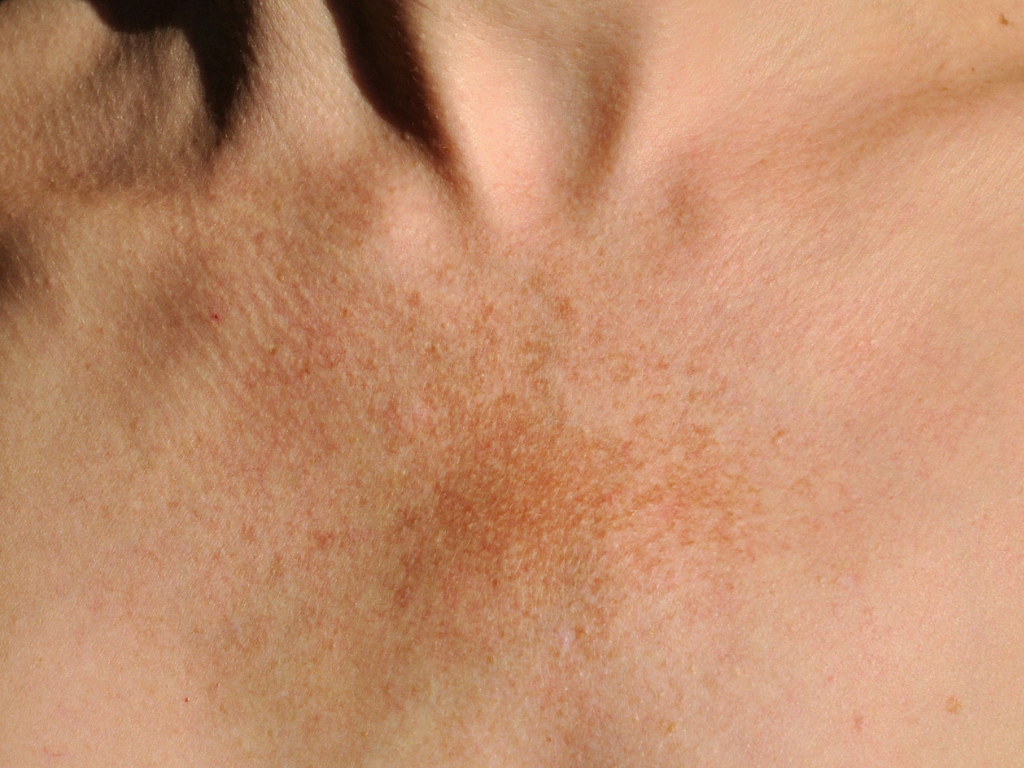Przebarwienia typu melasma na dekolcie u kobiety - przykład zmian skórnych