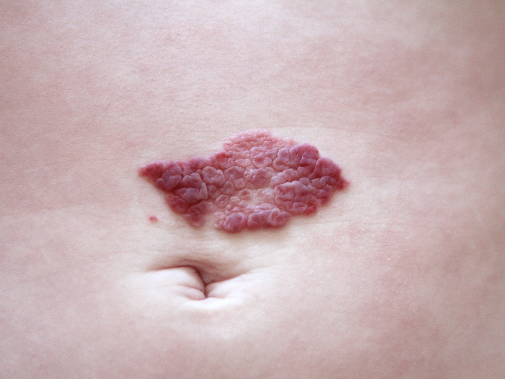 Zdjęcie naczyniaka przy pępku pacjentki przed zabiegiem laserowego usuwania naczyniaków