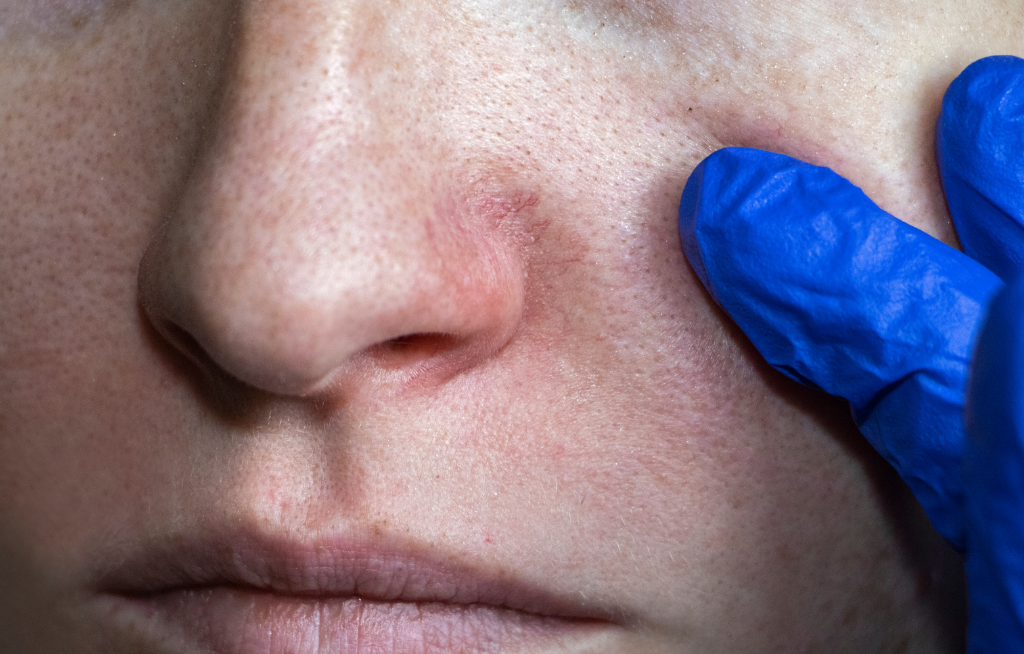 Lekarz w rękawiczce ocenia naczynka na nosie pacjentki podczas konsultacji dermatologicznej