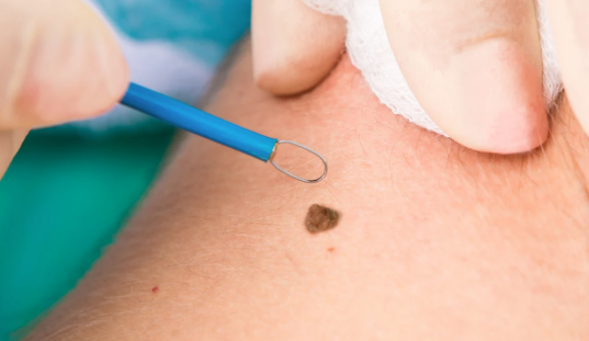 usuwanie odstającej ciemnej zmiany skórnej na ciele