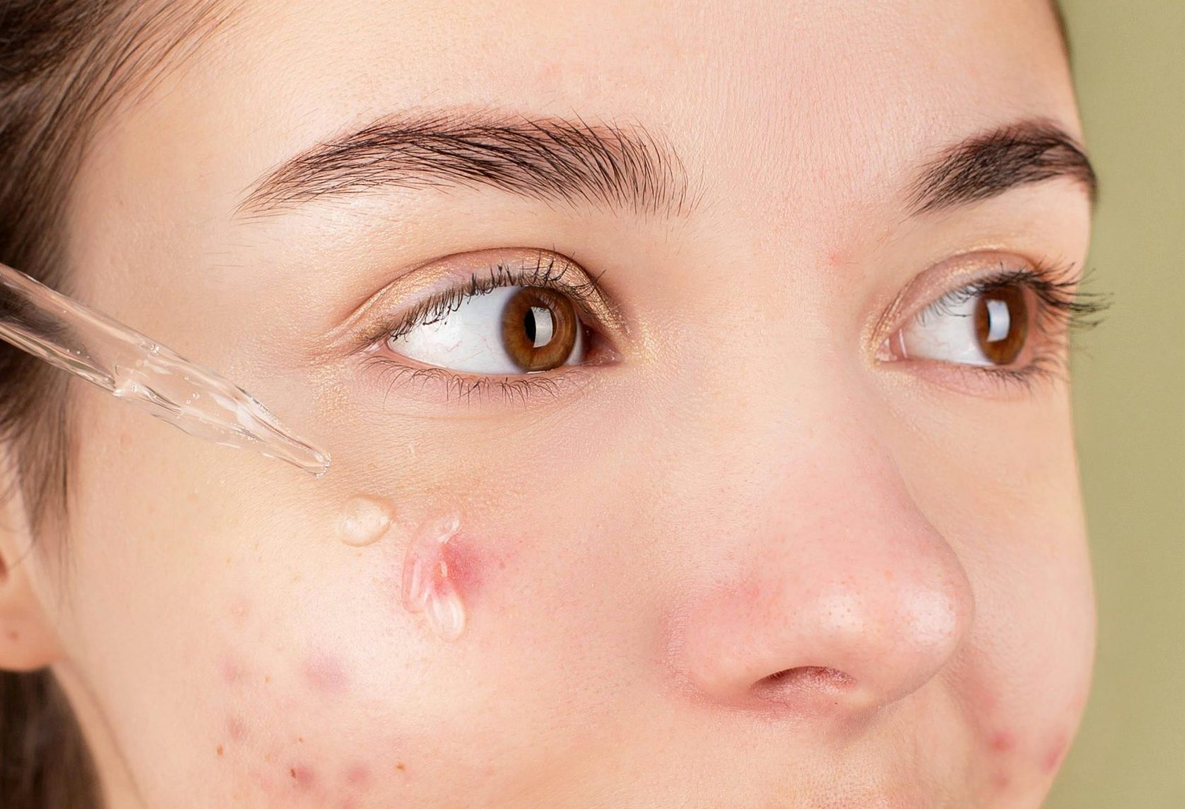 Nastolatka z trądzikiem nakładająca serum