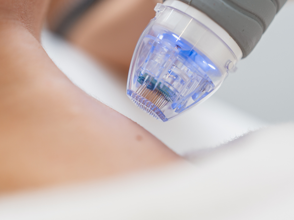 Urządzenie do radiofrekwencji mikroigłowej w powiększeniu