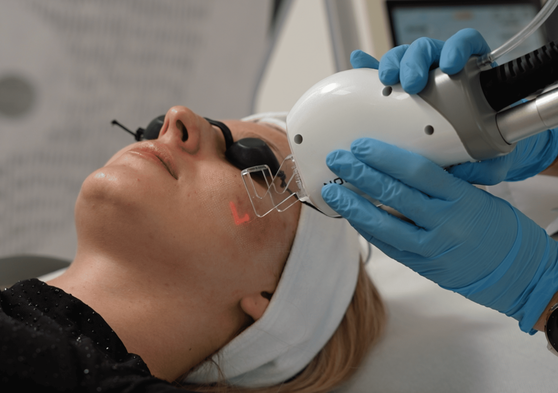 Lekarz FEBUMED wykonuje zabieg laserowego usuwania blizn trądzikowych przykładając laser frakcyjny do twarzy pacjentki