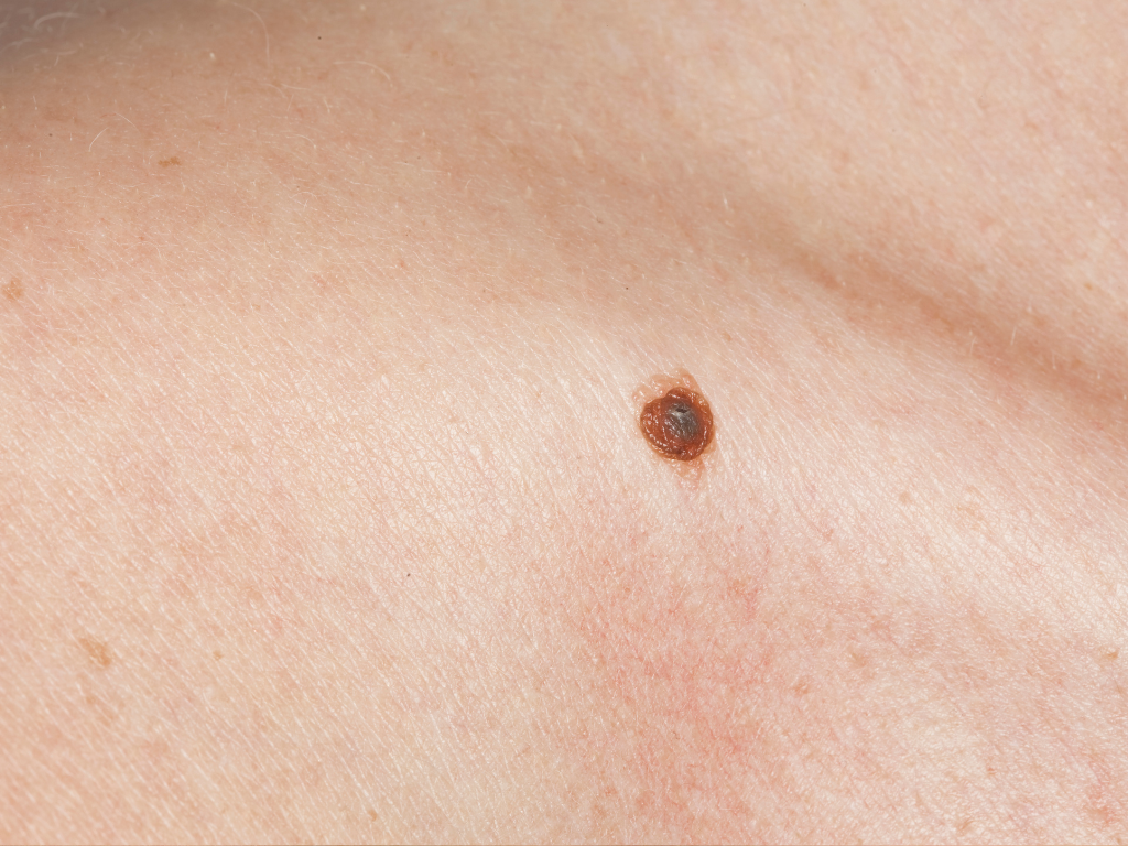 Zmiana skórna w okolicy obojczyka mająca znamiona czerniaka