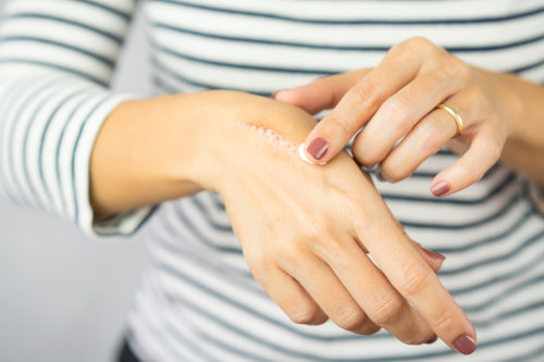 Jak pozbyć się blizn