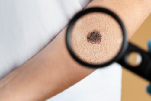 Na czym polega łyżeczkowanie zmian skórnych? Jakie są wskazania do zabiegu łyżeczkowania?