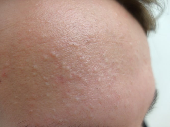 Trądzik pospolity na czole