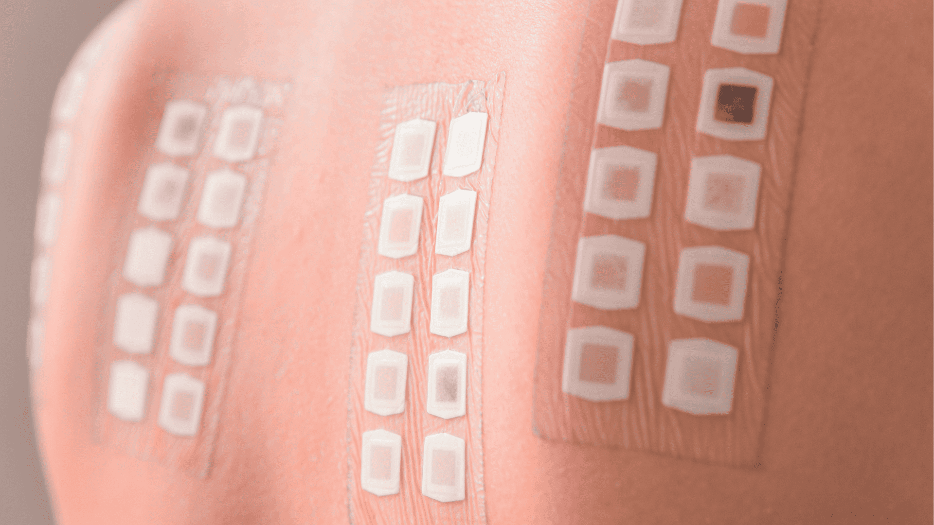 Płatki z alergenami przyklejone do pleców pacjenta