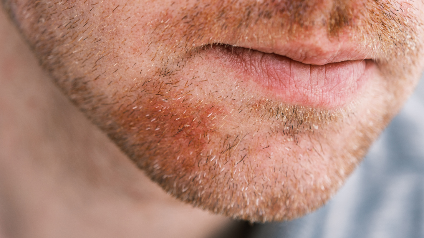 Dolna część twarzy mężczyzny z kilkudniowym nieogolonym zarostem. W obrębie ust nie pokazujących emocji można zauważyć zaczerwienienia.