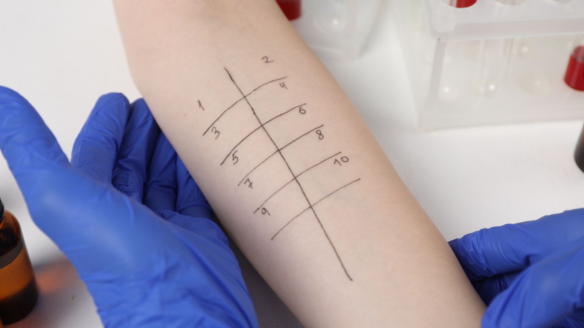 Zbliżenie na przedramię pacjenta z namalowanymi numerami od 1 do 10, podzielonymi na dwie kolumny.