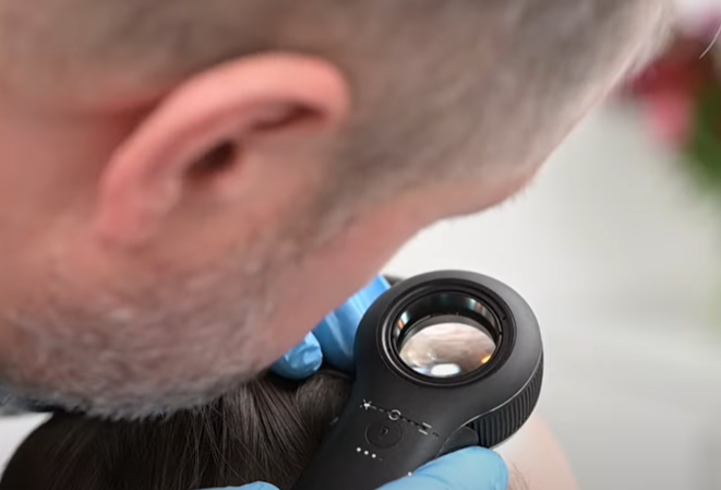 lekarz bada dermatoskopem skórę głowy pacjentki w dużym zbliżeniu