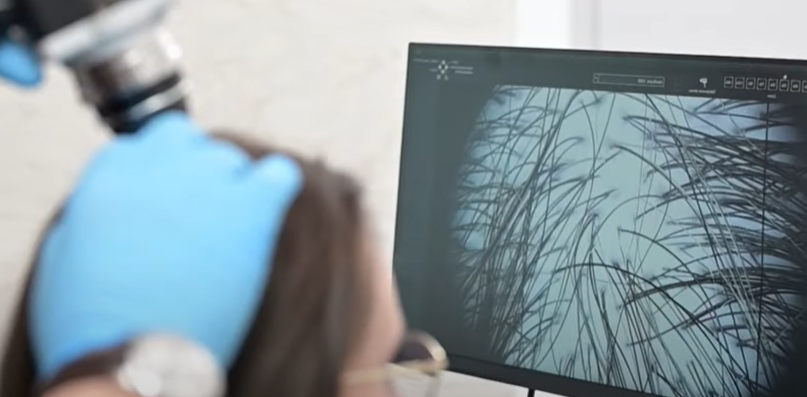 lekarz przykładający kamerę wideotrichoskopu do głowy pacjentki, na ekranie komputera przed pacjentką widoczne włosy i mieszki włosowe w dużym powiększeniu