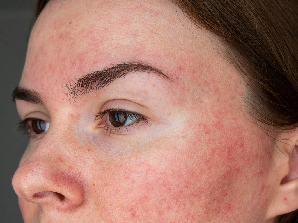Pacjentka z trądzikiem różowatym - rumień na policzkach, nosie i czole przed zabiegiem laserowym