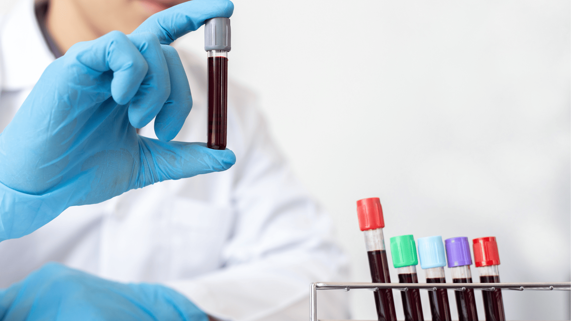 probówki z krwią po pobraniu krwi od pacjenta